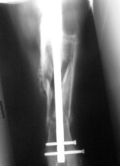 Retrograde Femoral Rod (Implant 233)